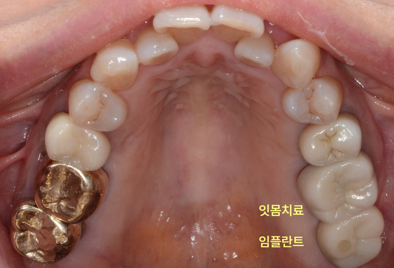 윗몸치료와 임플란트가 완료된 상악 구강 내 사진