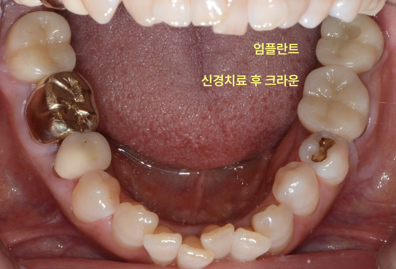 임플란트 및 신경치료 후 크라운이 완료된 하악 구강 내 사진