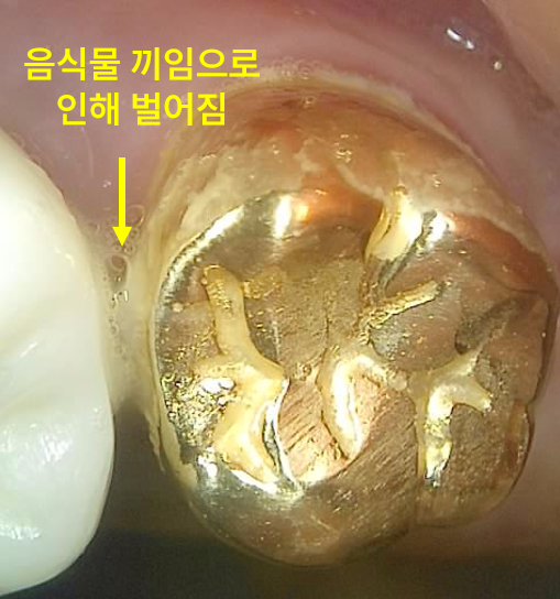 음식물 끼임으로 인해 벌어진 치아 틈새 구강 내 사진