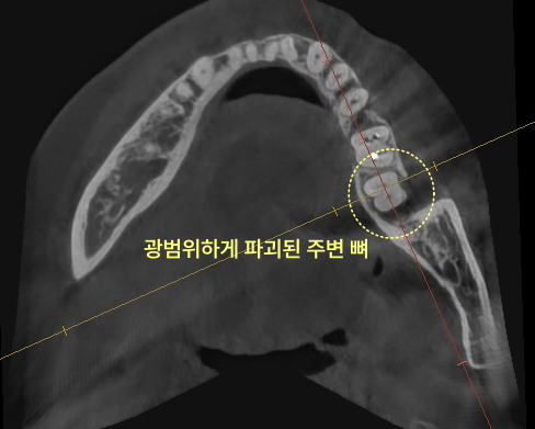 광범위하게 파괴된 주위 뼈를 보여주는 치과 CT 사진