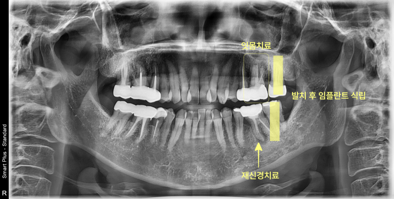 윗몸치료, 발치 후 임플란트 식립, 재신경치료를 표시한 파노라마 방사선 사진