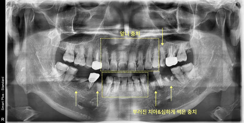 소사동치과 콜라 자주 마시면 치아는? 관련 사진 2