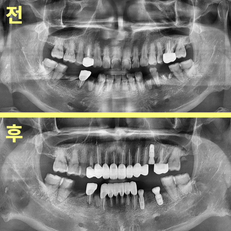 소사동치과 콜라 자주 마시면 치아는? 관련 사진 30