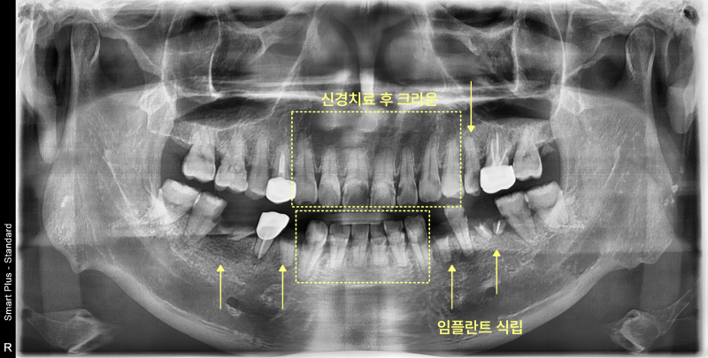 소사동치과 콜라 자주 마시면 치아는? 관련 사진 9