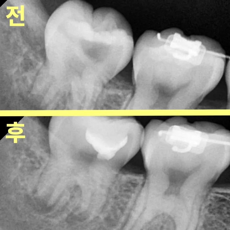 비전동치과 아이 깊은 충치, 신경치료 피하는 법