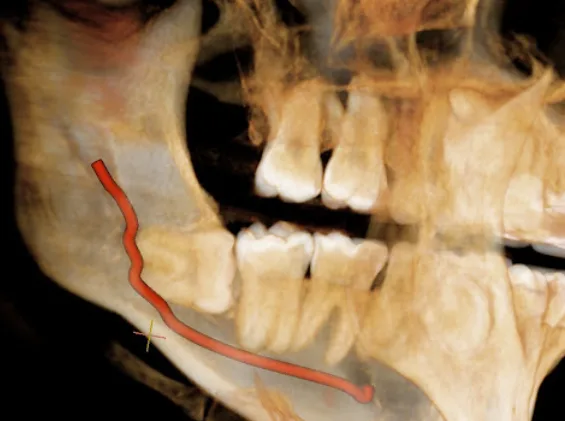 하악골 내부 신경관의 위치를 보여주는 3D CT 이미지