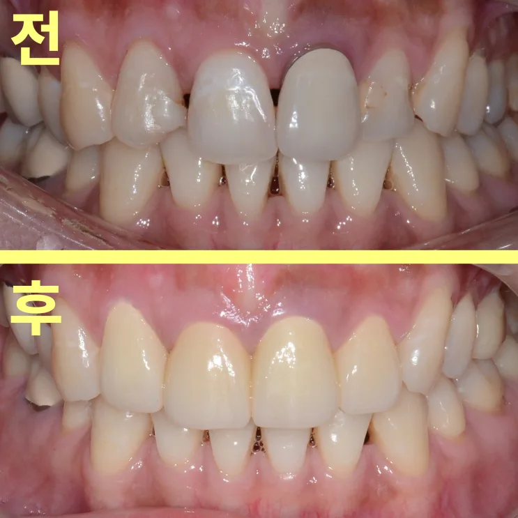 소사동치과 앞니 크라운 검은 선은 왜 생길까요?