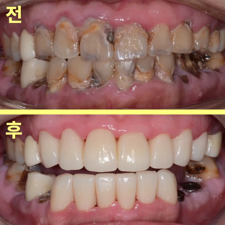 소사동치과 콜라 자주 마시면 치아는?