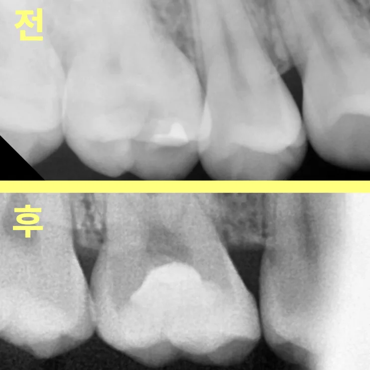 소사벌치과 깊은 충치, 신경 살리는 치료도 가능할까요?