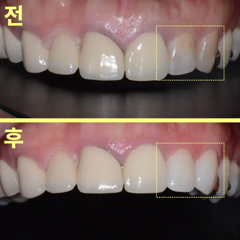소사벌치과 앞니 충치 깊이가 치료를 바꿉니다