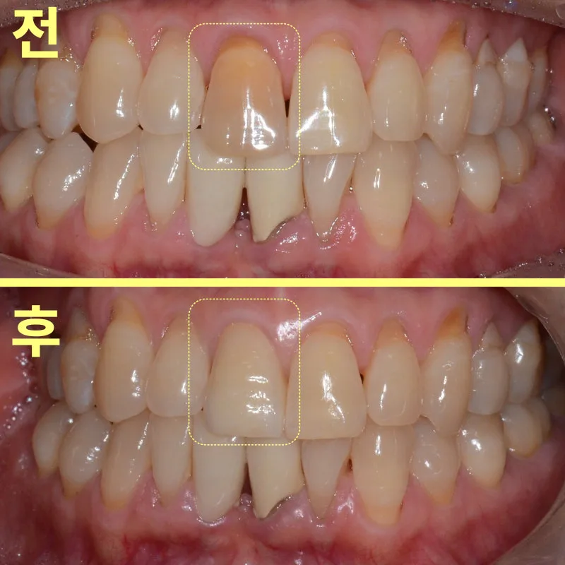 환자 구강 내 상악 정면 사진. 상단은 치료 전, 하단은 치료 후. 우측 중절치와 측절치에 노란색 점선 사각형 표시됨.