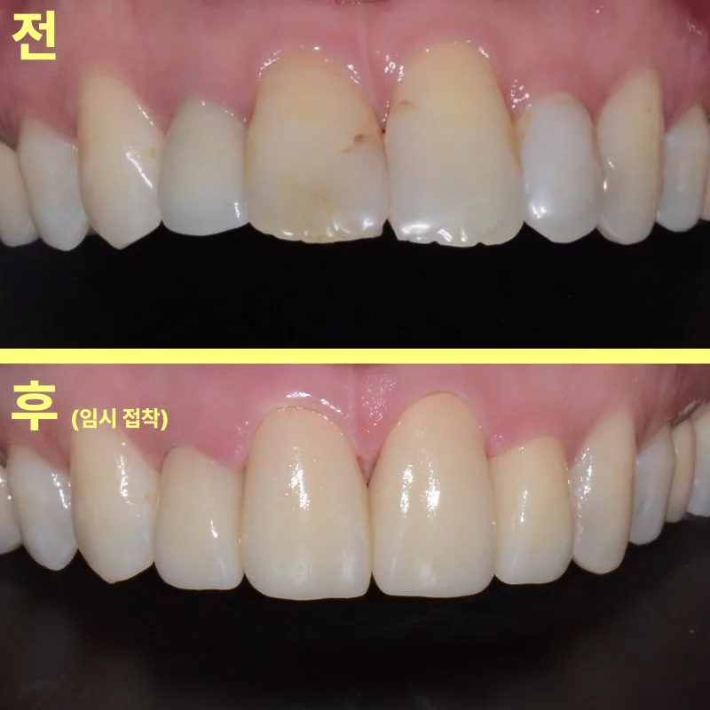 안성공도치과 앞니 보철 전 확인할 조건