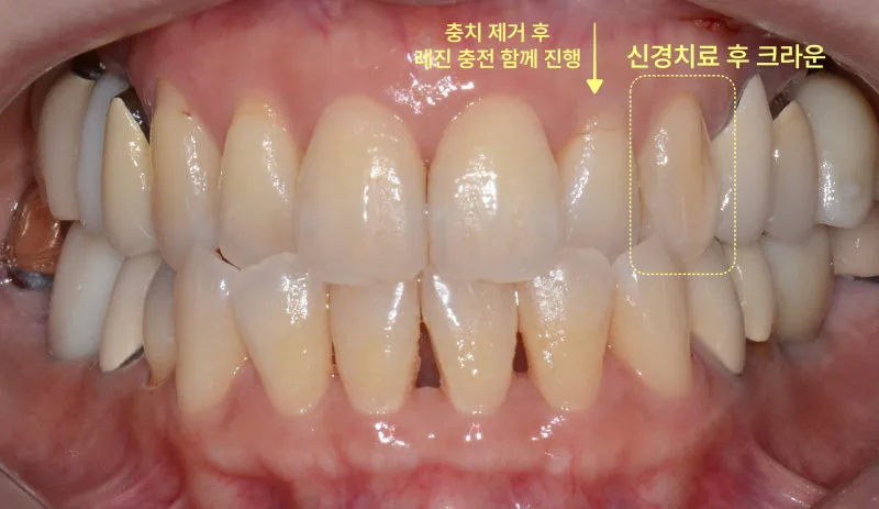 환자의 구강 내 사진으로, 충치 제거 후 레진 충전과 신경 치료 후 크라운 수복이 완료된 상악 좌측 앞니 부위를 노란색 점선으로 표시한 모습