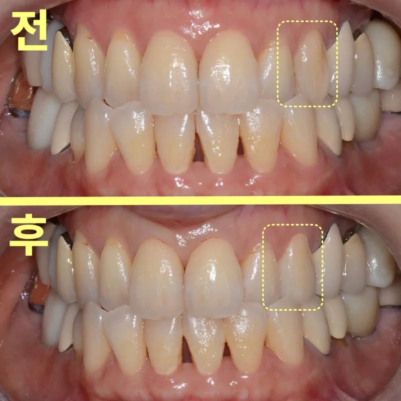 치료 전후 환자의 구강 내 사진 비교. 상악 좌측 앞니 부위의 충치와 치아 형태가 개선된 것을 노란색 점선으로 표시한 모습