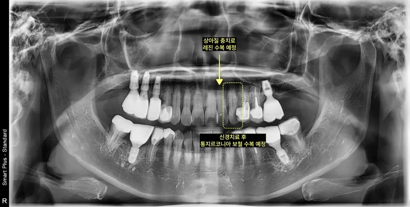 파노라마 방사선 사진에서 상악 좌측 앞니의 상아질 충치 치료 및 레진 수복 예정, 신경 치료 후 통지르코니아 보철 수복 예정 부위를 표시한 모습