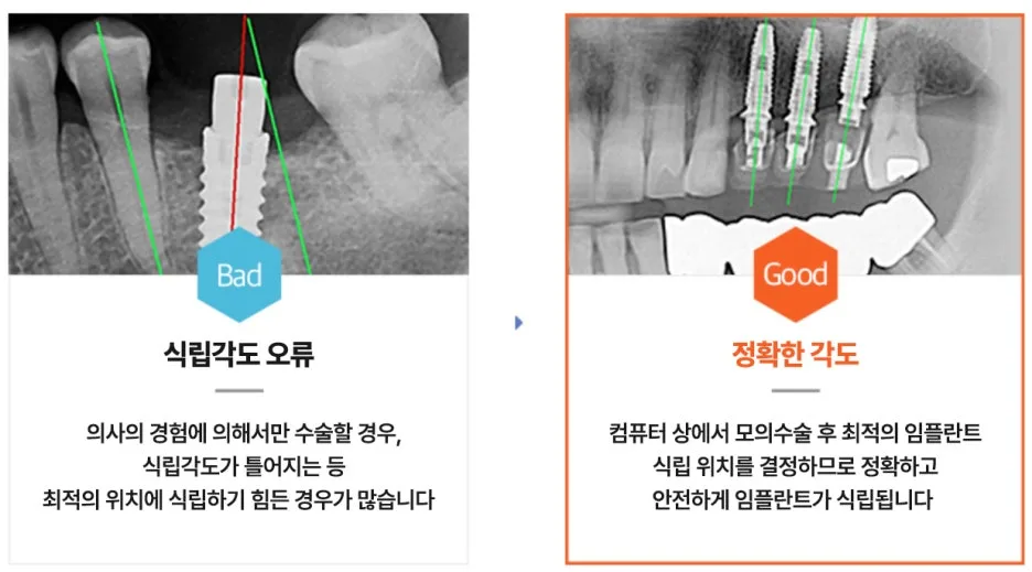 임플란트 식립 각도 오류와 정확한 각도를 비교하는 엑스레이 이미지