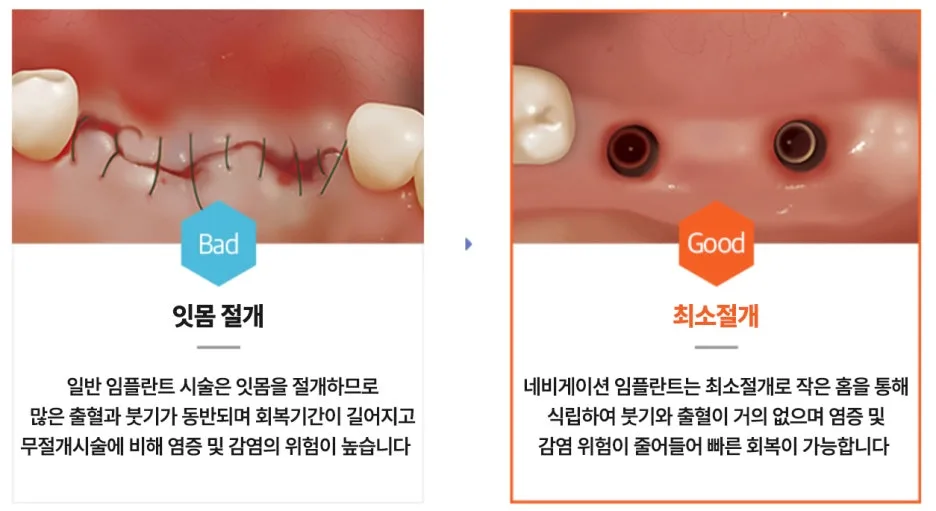 잇몸 절개와 최소 절개를 비교하는 임상 사진