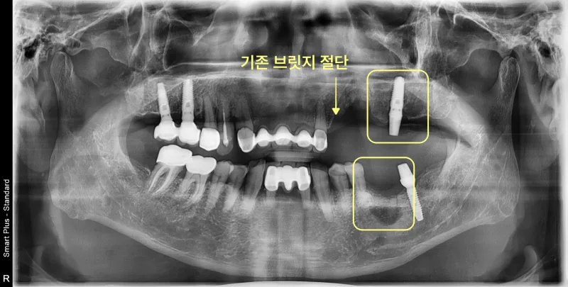 기존 브릿지 절단 및 임플란트 제거 후 파노라마 방사선 사진