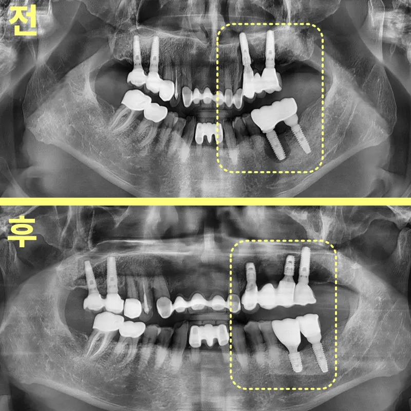 평택역치과 임플란트 재수술은 어떻게 결정할까요