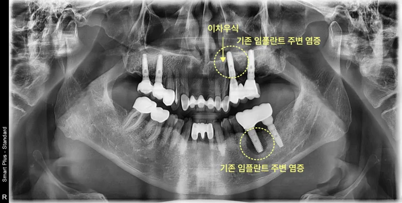 기존 임플란트 주위염 및 이차 우식 소견이 보이는 파노라마 방사선 사진
