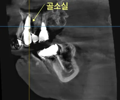 상악 좌측 임플란트 주변 골소실을 보여주는 치과 CT 사진