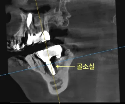 하악 우측 임플란트 주변 골소실을 보여주는 치과 CT 사진