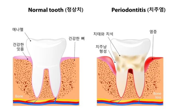 정상 치아와 치주염이 진행된 치아의 단면을 비교한 의료 일러스트