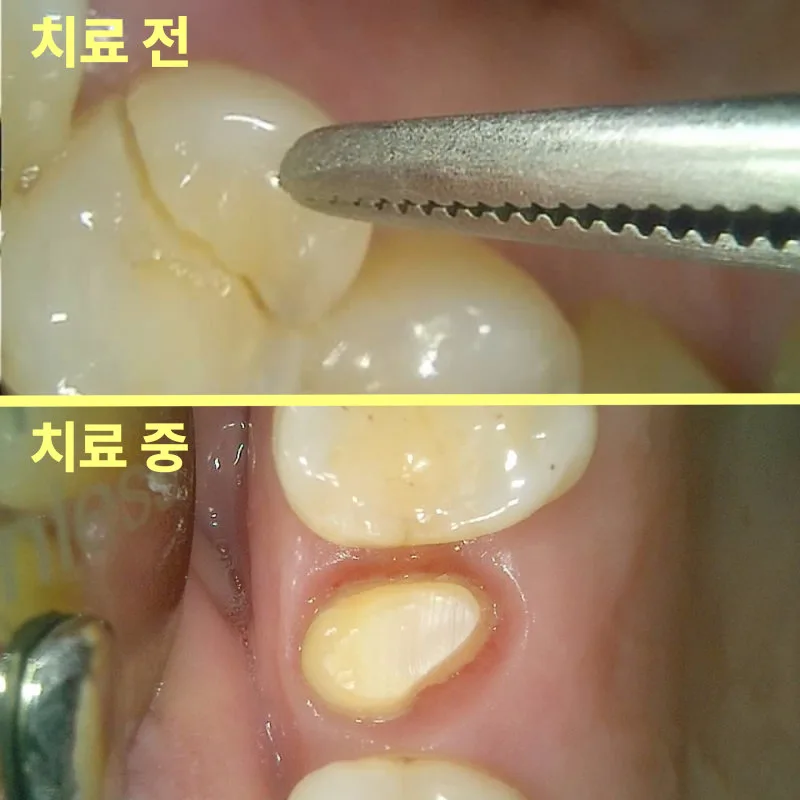 치료 전 균열이 있는 상악 좌측 작은 어금니와 치료 중 다듬어진 치아를 비교한 사진