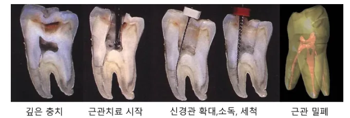 깊은 충치부터 근관 밀폐까지 근관치료의 단계별 과정을 보여주는 치아 단면 이미지
