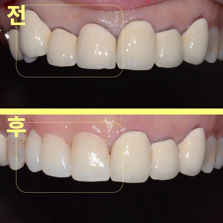 평택비전동치과 앞니 브릿지 충치, 전체 제거가 필요한 이유